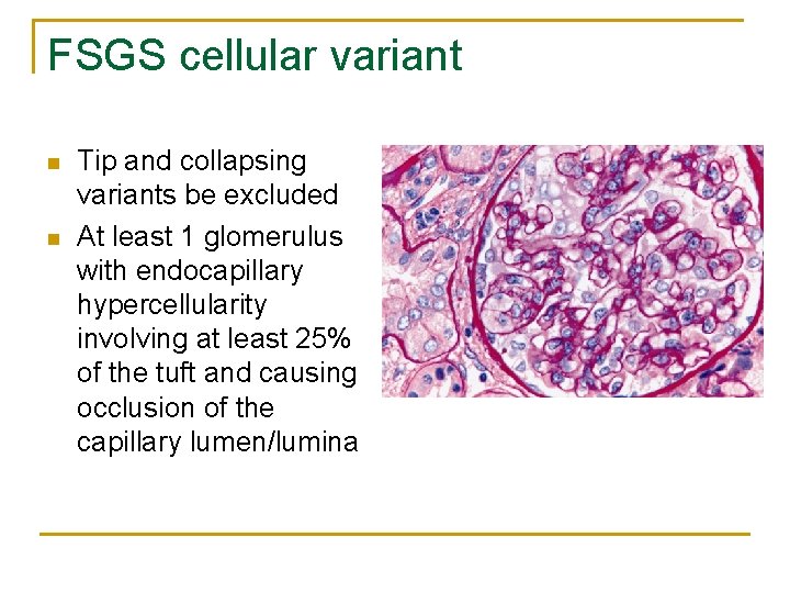 FSGS cellular variant n n Tip and collapsing variants be excluded At least 1 FSGS cellular variant n n Tip and collapsing variants be excluded At least 1