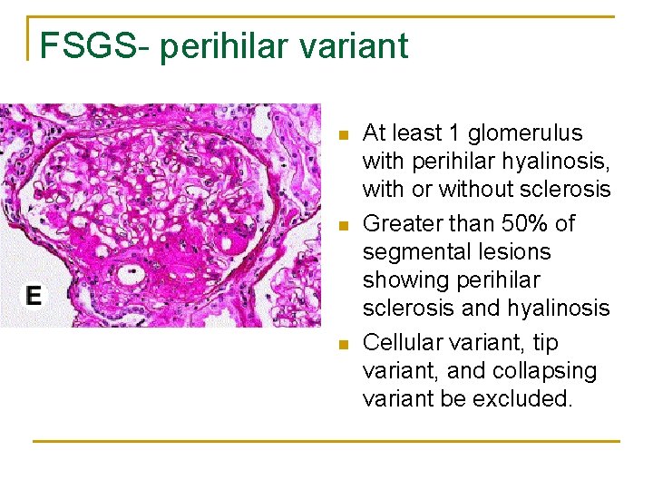 FSGS- perihilar variant n n n At least 1 glomerulus with perihilar hyalinosis, with FSGS- perihilar variant n n n At least 1 glomerulus with perihilar hyalinosis, with
