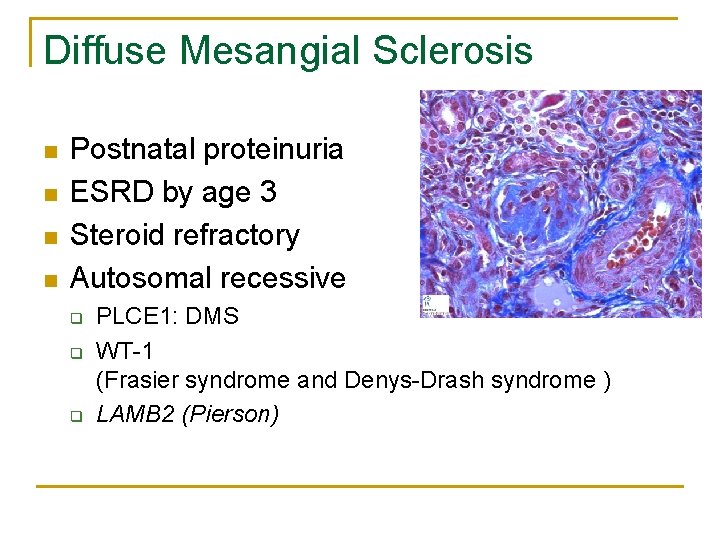 Diffuse Mesangial Sclerosis n n Postnatal proteinuria ESRD by age 3 Steroid refractory Autosomal Diffuse Mesangial Sclerosis n n Postnatal proteinuria ESRD by age 3 Steroid refractory Autosomal