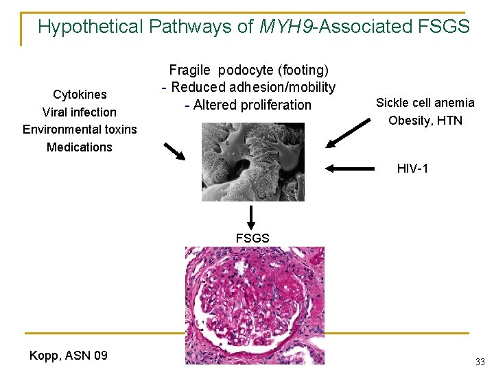 Hypothetical Pathways of MYH 9 -Associated FSGS Cytokines Viral infection Environmental toxins Medications Fragile Hypothetical Pathways of MYH 9 -Associated FSGS Cytokines Viral infection Environmental toxins Medications Fragile