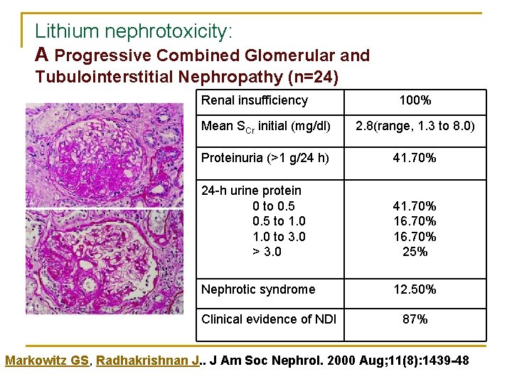 Lithium nephrotoxicity: A Progressive Combined Glomerular and Tubulointerstitial Nephropathy (n=24) Renal insufficiency 100% Mean Lithium nephrotoxicity: A Progressive Combined Glomerular and Tubulointerstitial Nephropathy (n=24) Renal insufficiency 100% Mean