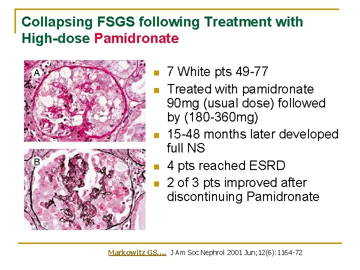 Collapsing FSGS following Treatment with High-dose Pamidronate n n n 7 White pts 49 Collapsing FSGS following Treatment with High-dose Pamidronate n n n 7 White pts 49