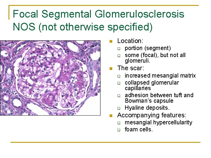Focal Segmental Glomerulosclerosis NOS (not otherwise specified) n Location: q q n The scar: Focal Segmental Glomerulosclerosis NOS (not otherwise specified) n Location: q q n The scar: