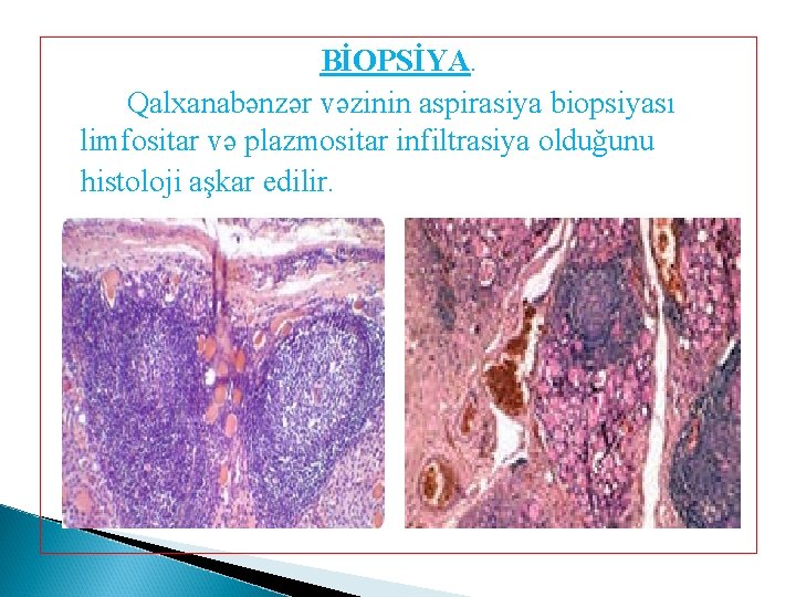 BİOPSİYA. Qalxanabənzər vəzinin aspirasiya biopsiyası limfositar və plazmositar infiltrasiya olduğunu histoloji aşkar edilir. 