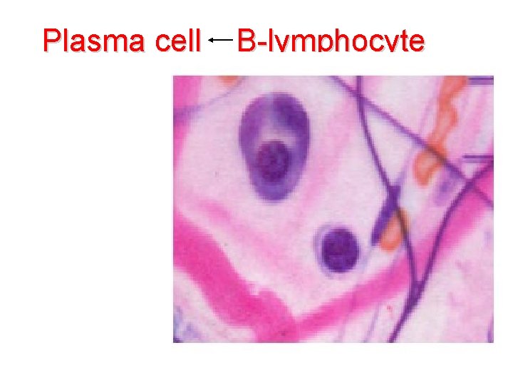 Plasma cell B-lymphocyte 