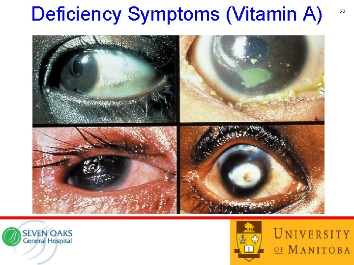 Deficiency Symptoms (Vitamin A) 22 