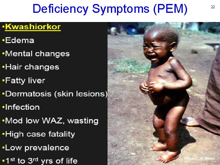 Deficiency Symptoms (PEM) 22 