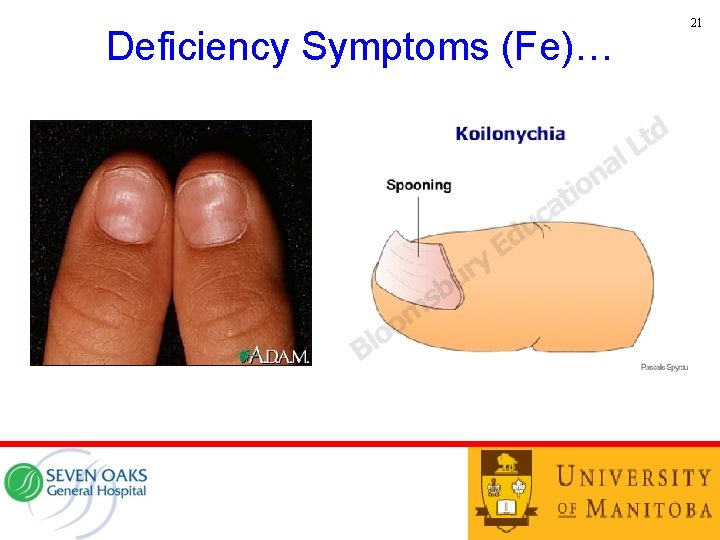 Deficiency Symptoms (Fe)… • YYY 21 