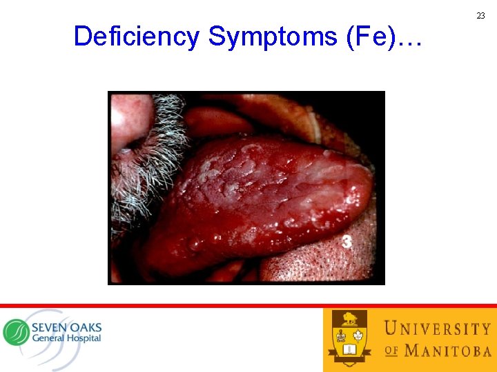 23 Deficiency Symptoms (Fe)… 