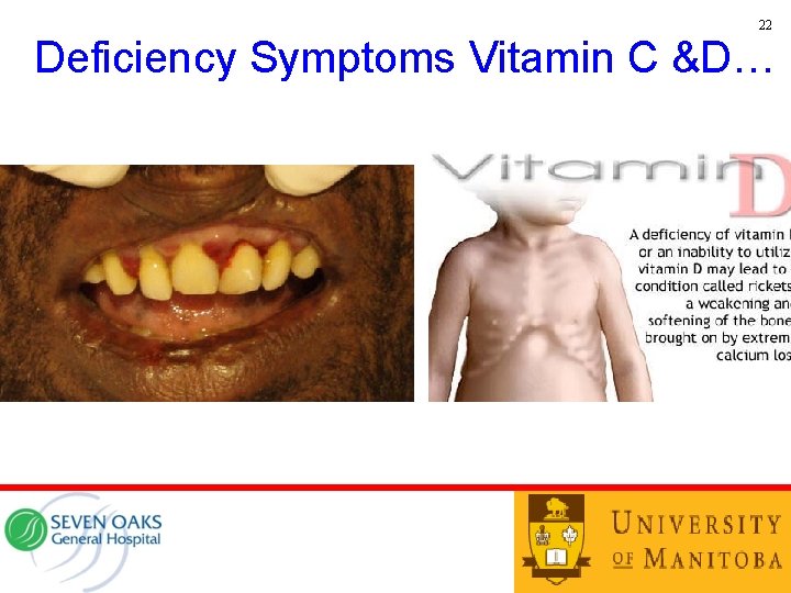 22 Deficiency Symptoms Vitamin C &D… 