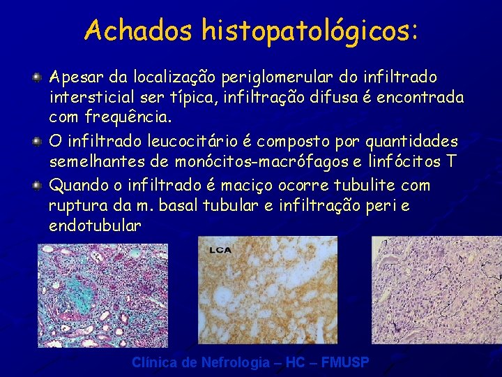 Achados histopatológicos: Apesar da localização periglomerular do infiltrado intersticial ser típica, infiltração difusa é