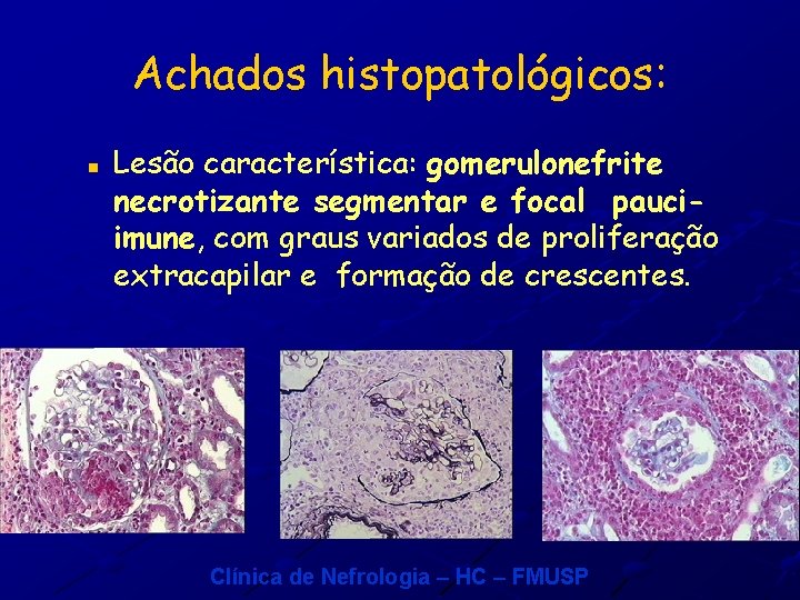 Achados histopatológicos: n Lesão característica: gomerulonefrite necrotizante segmentar e focal pauciimune, com graus variados