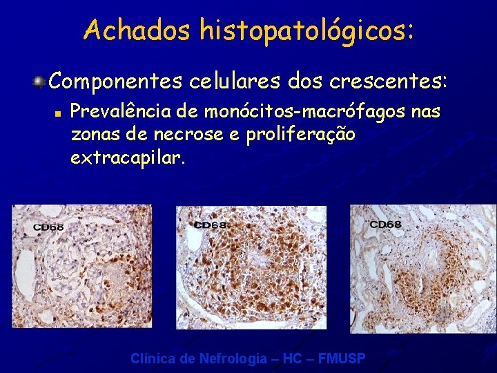Achados histopatológicos: Componentes celulares dos crescentes: n Prevalência de monócitos-macrófagos nas zonas de necrose