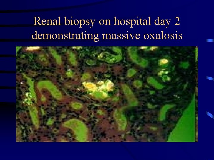 Renal biopsy on hospital day 2 demonstrating massive oxalosis 