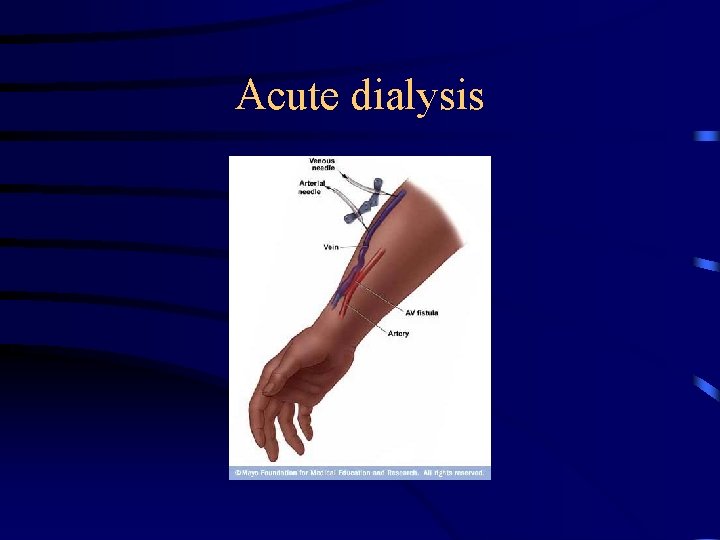 Acute dialysis 