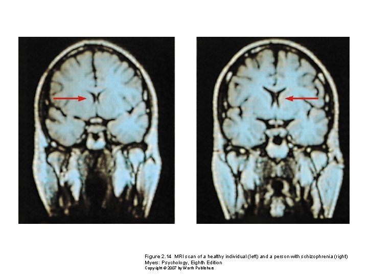 Figure 2. 14 MRI scan of a healthy individual (left) and a person with