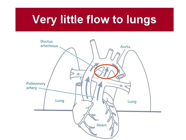 Very little flow to lungs 