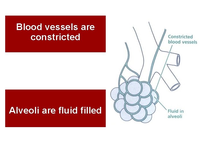 Blood vessels are constricted Alveoli are fluid filled 