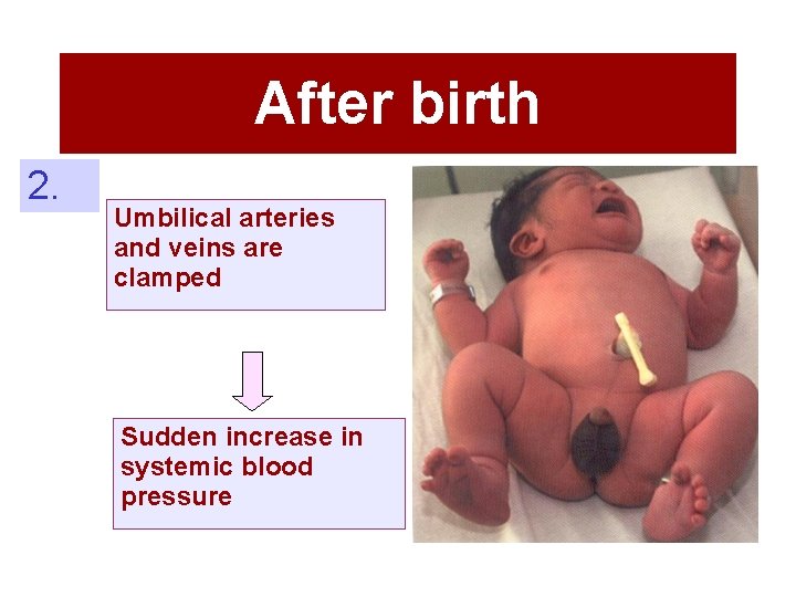 After birth 2. Umbilical arteries and veins are clamped Sudden increase in systemic blood