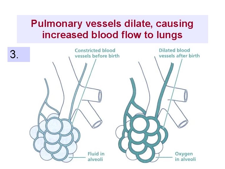 Pulmonary vessels dilate, causing increased blood flow to lungs 3. 