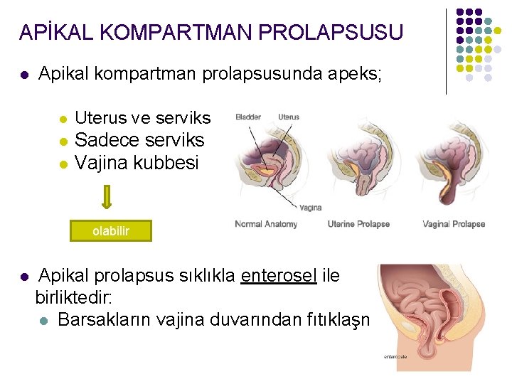 APİKAL KOMPARTMAN PROLAPSUSU l Apikal kompartman prolapsusunda apeks; l Uterus ve serviks l Sadece