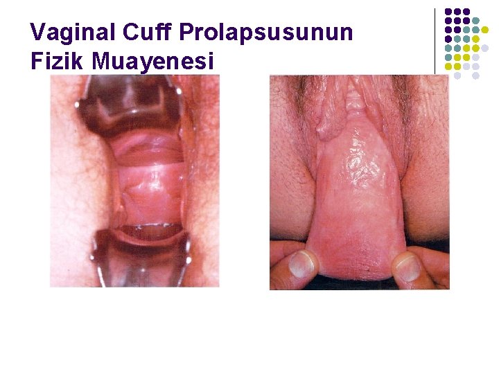 Vaginal Cuff Prolapsusunun Fizik Muayenesi 