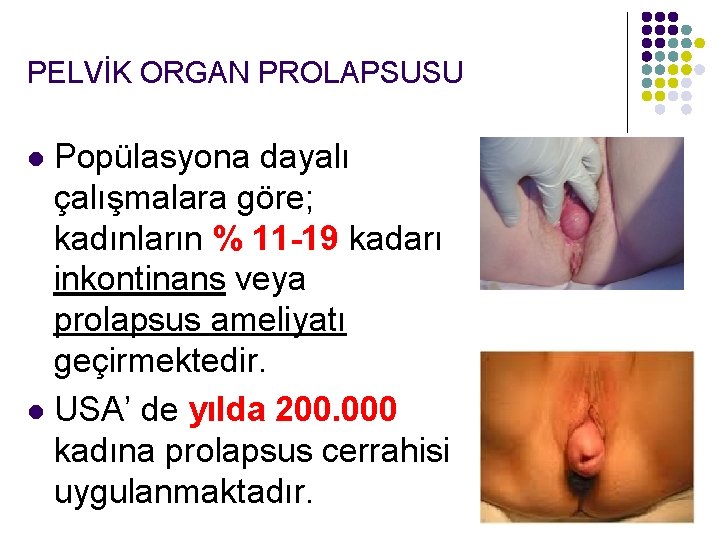 PELVİK ORGAN PROLAPSUSU Popülasyona dayalı çalışmalara göre; kadınların % 11 -19 kadarı inkontinans veya