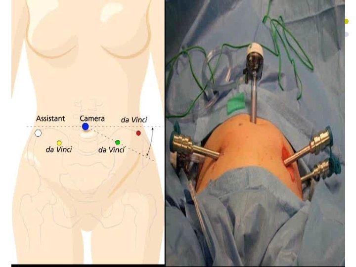 Cerrahi etaplar 4. Presakral boşluğa girilir ve – Monopolar eğri makas longitudinal ligament bulunur