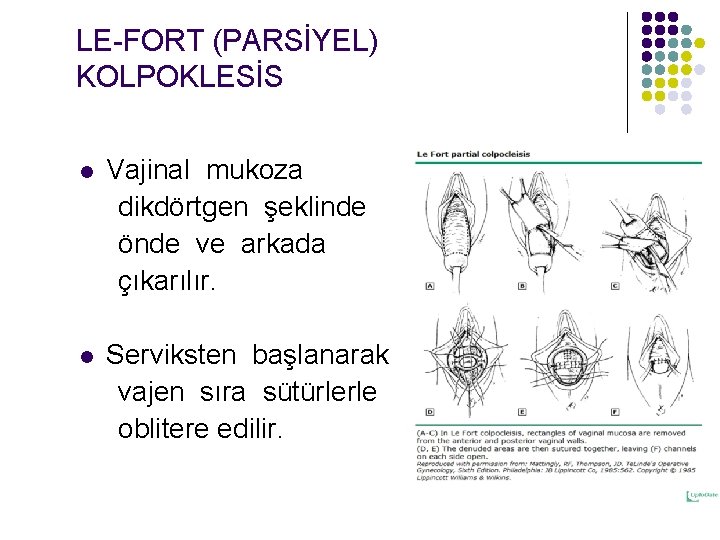 LE-FORT (PARSİYEL) KOLPOKLESİS Vajinal mukoza dikdörtgen şeklinde önde ve arkada çıkarılır. l Serviksten başlanarak