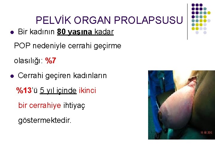 PELVİK ORGAN PROLAPSUSU l Bir kadının 80 yaşına kadar POP nedeniyle cerrahi geçirme olasılığı: