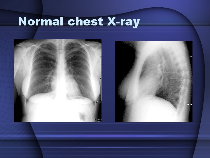 Normal chest X-ray Normal chest X-ray