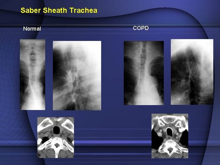 Saber Sheath Trachea Normal COPD Saber Sheath Trachea Normal COPD