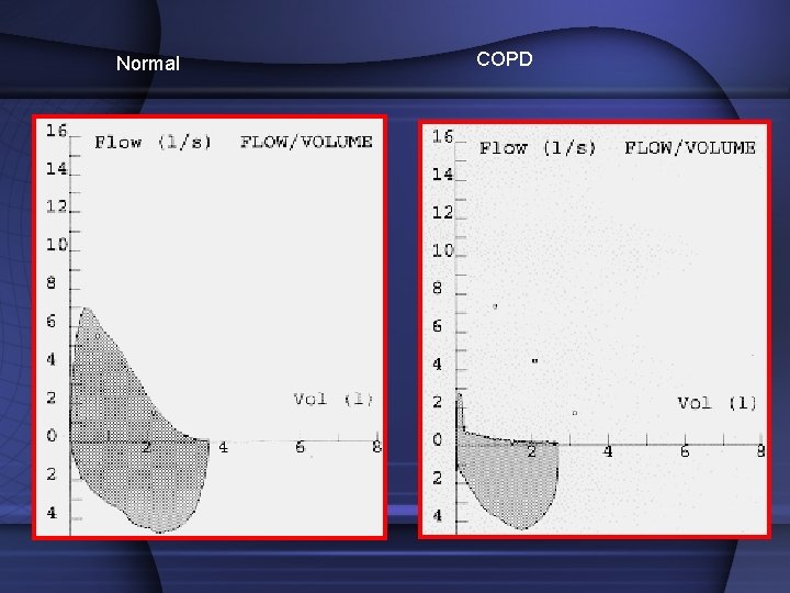 Normal COPD Normal COPD