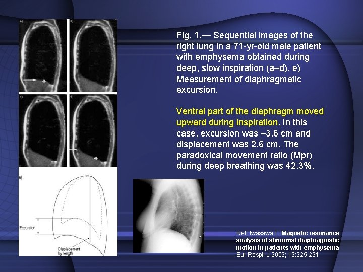 Fig. 1. — Sequential images of the right lung in a 71 -yr-old male Fig. 1. — Sequential images of the right lung in a 71 -yr-old male