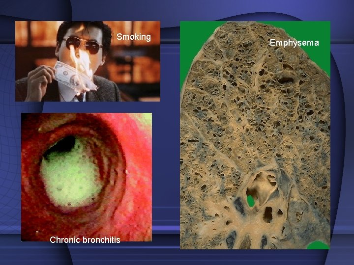 Smoking Chronic bronchitis Emphysema Smoking Chronic bronchitis Emphysema