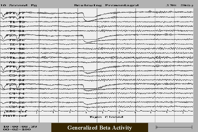 Generalized Beta Activity 