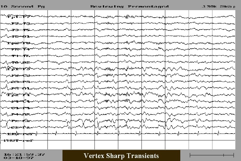 Vertex Sharp Transients 