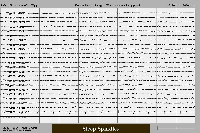 Sleep Spindles 