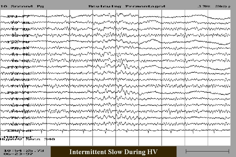 Intermittent Slow During HV 