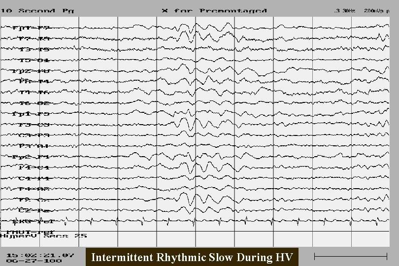 Intermittent Rhythmic Slow During HV 