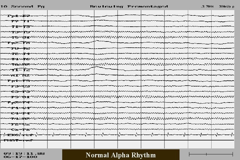 Normal Alpha Rhythm 