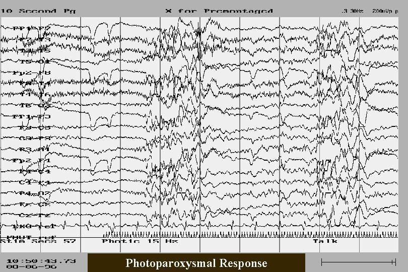 Photoparoxysmal Response 