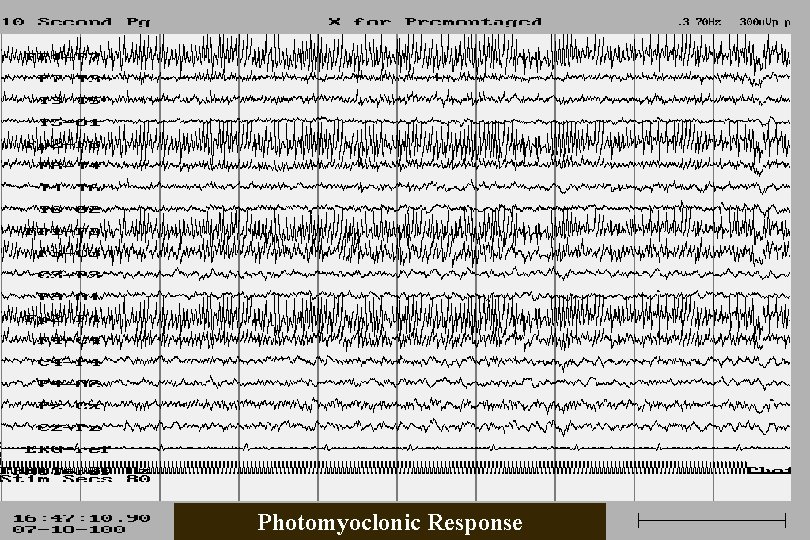 Photomyoclonic Response 