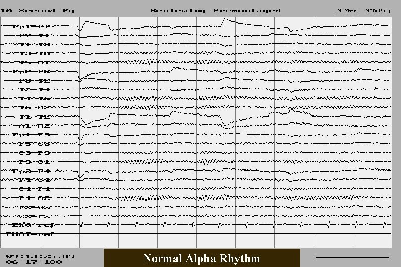 Normal Alpha Rhythm 