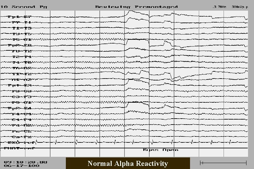 Normal Alpha Reactivity 