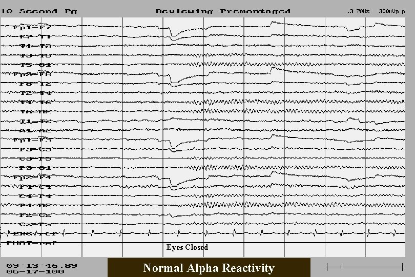 Eyes Closed Normal Alpha Reactivity 