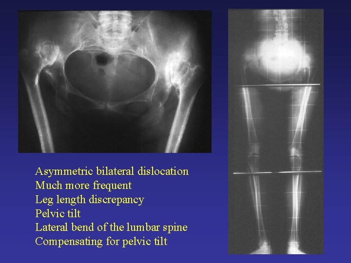 Asymmetric bilateral dislocation Much more frequent Leg length discrepancy Pelvic tilt Lateral bend of Asymmetric bilateral dislocation Much more frequent Leg length discrepancy Pelvic tilt Lateral bend of