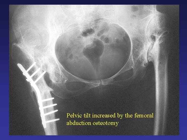 Pelvic tilt increased by the femoral abduction osteotomy Pelvic tilt increased by the femoral abduction osteotomy