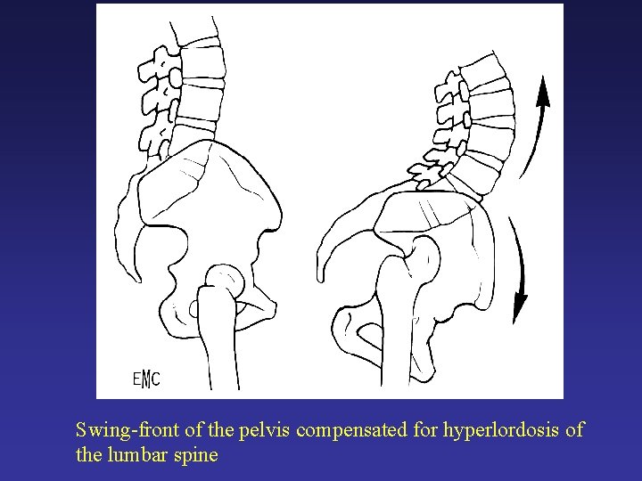 Swing-front of the pelvis compensated for hyperlordosis of the lumbar spine Swing-front of the pelvis compensated for hyperlordosis of the lumbar spine