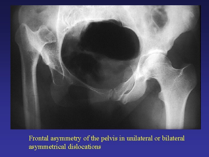 Frontal asymmetry of the pelvis in unilateral or bilateral asymmetrical dislocations Frontal asymmetry of the pelvis in unilateral or bilateral asymmetrical dislocations